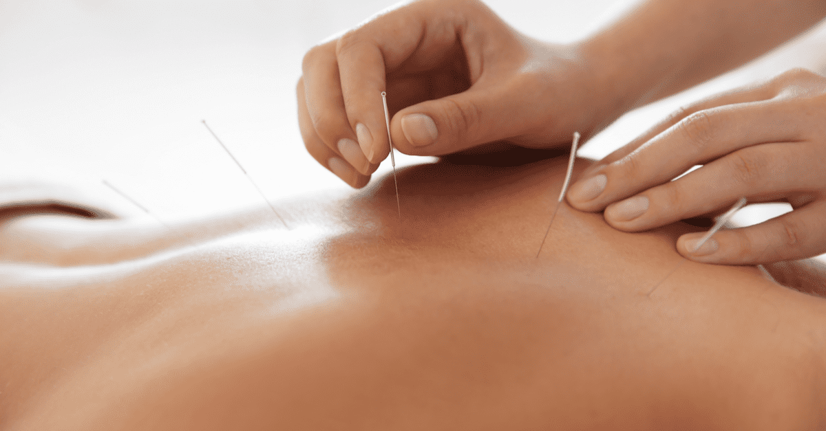 Séance d'acupuncture sur le dos d'un patient