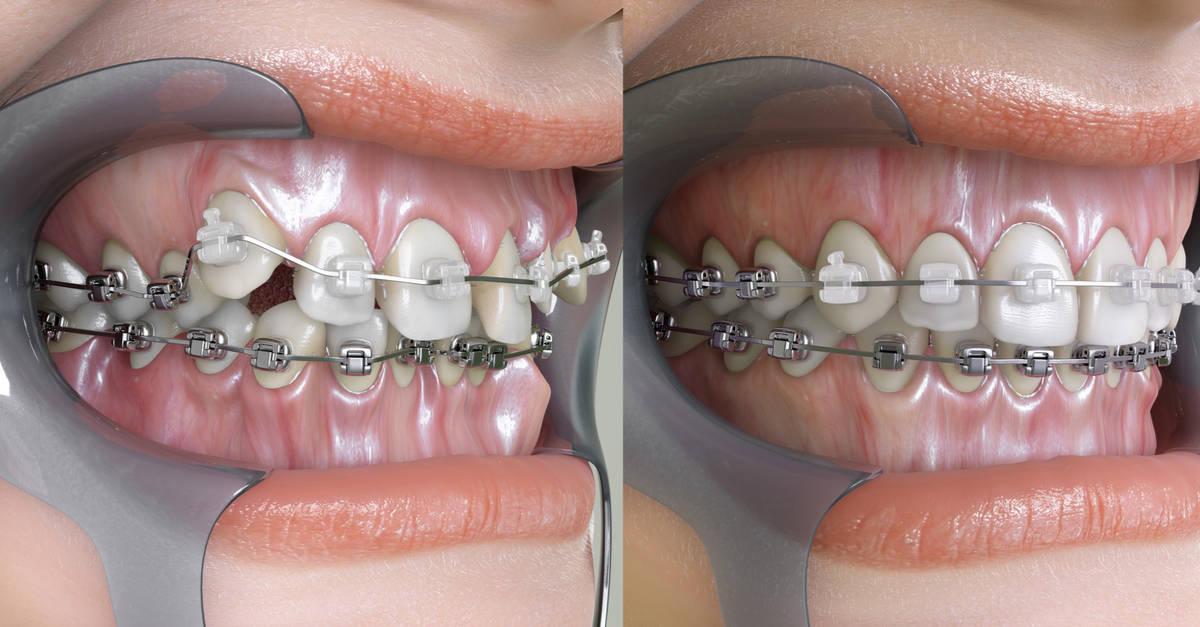 Modélisation 3d d'une dentition Avant/Après orthodontie